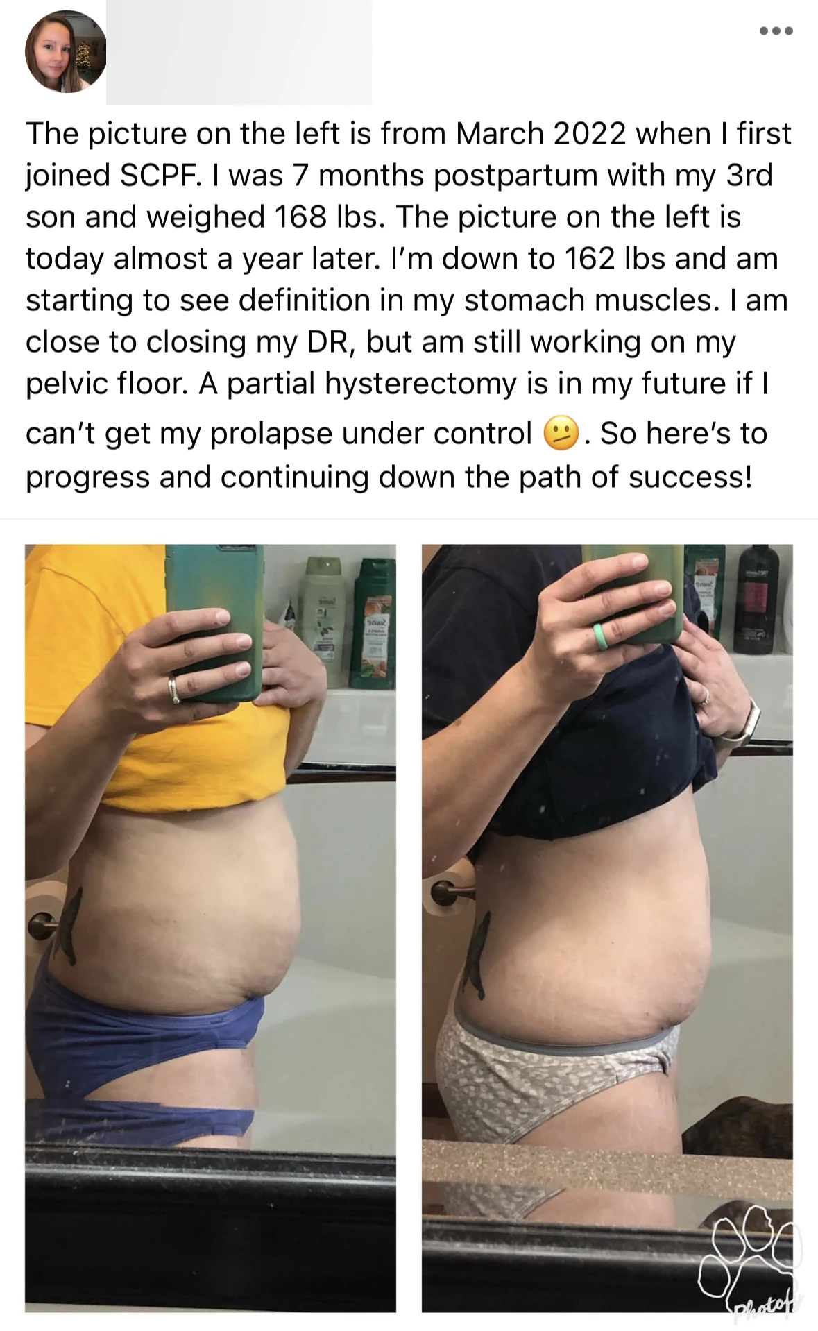 Specific transformation with weight loss, DR closing, and visible progress photos postpartum with prolapse context.