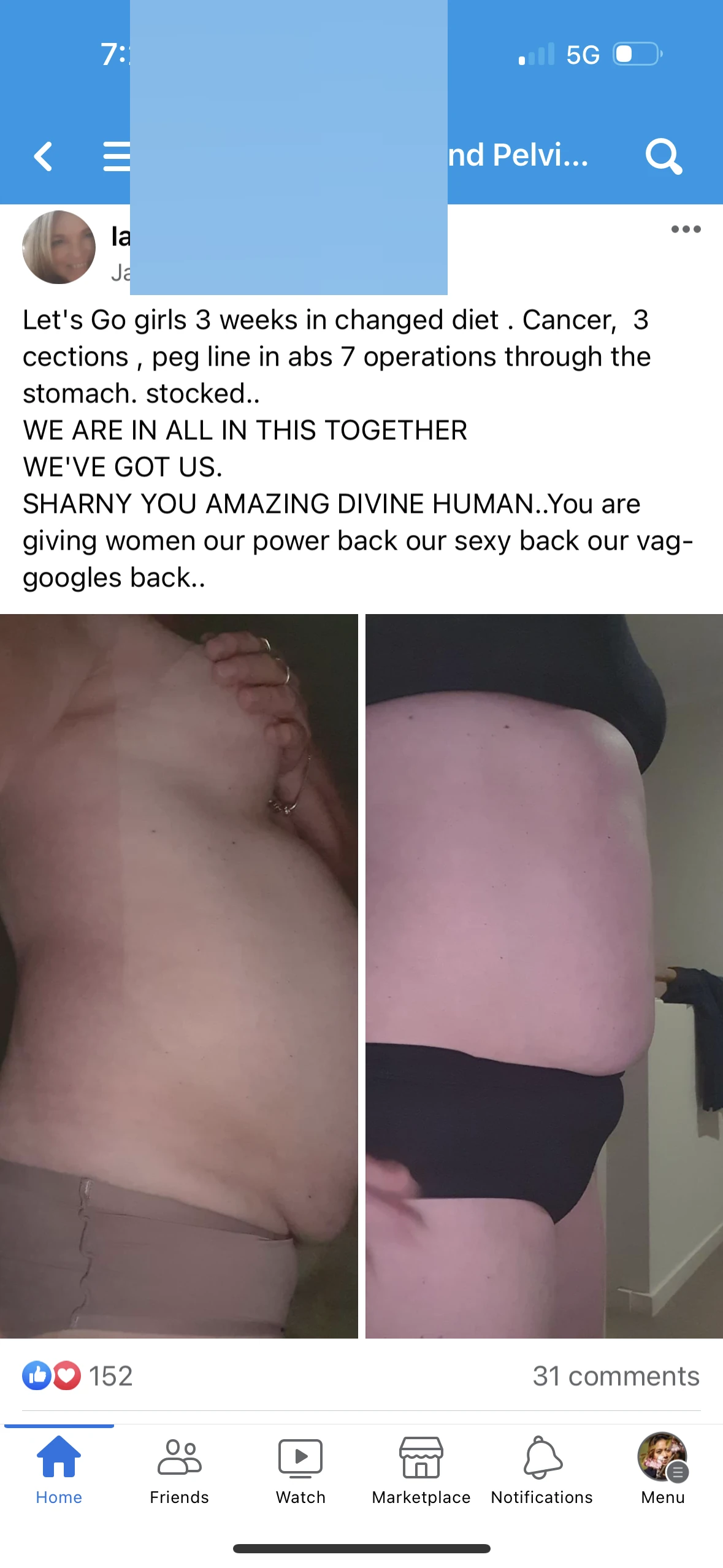 Specific, dramatic backstory (cancer, 3 c-sections, 7 abdominal operations, peg line) with visible 3-week transformation